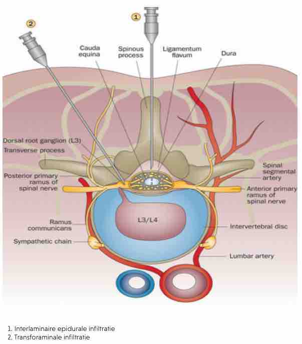 epidurale injectie