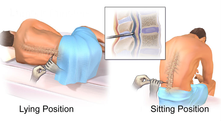 positie epidurale injectie